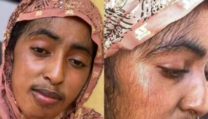 مناشدة من شابة سودانية للأطباء والمختصين لعلاجها من نمو غير طبيعي للشعر في الوجه​متابعات : تي نيوز